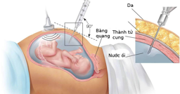 Hình ảnh chi tiết tin tức (NIPT) SÀNG LỌC TRƯỚC SINH LUÔN LÀ NGƯỜI BẠN ĐỒNG HÀNH LÝ TƯỞNG TRONG HÀNH TRÌNH MANG THAI Hình ảnh tin tức (NIPT) SÀNG LỌC TRƯỚC SINH LUÔN LÀ NGƯỜI BẠN ĐỒNG HÀNH LÝ TƯỞNG TRONG HÀNH TRÌNH MANG THAI