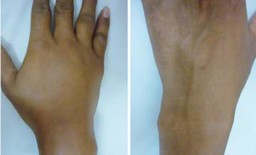 Hình ảnh chi tiết tin tức Phù mạch di truyền - Một cấp cứu hiếm gặp nhưng có thể tử vong Hình ảnh tin tức Phù mạch di truyền - Một cấp cứu hiếm gặp nhưng có thể tử vong