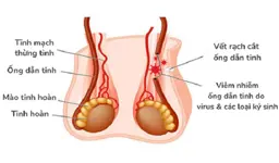 Hình ảnh chi tiết tin tức Viêm ống dẫn tinh điều trị như thế nào ? Hình ảnh tin tức Viêm ống dẫn tinh điều trị như thế nào ?