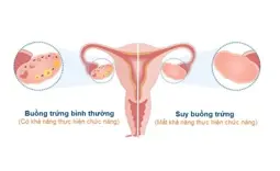 Hình ảnh chi tiết tin tức Suy buồng trứng: Nguyên nhân, triệu chứng, cách phòng ngừa Hình ảnh tin tức Suy buồng trứng: Nguyên nhân, triệu chứng, cách phòng ngừa